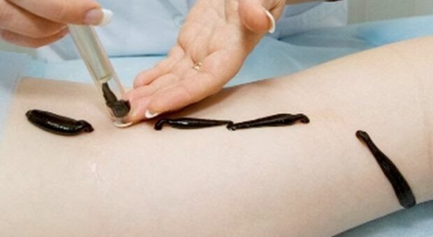 Лечение пиявками в санатории «Моршинский»