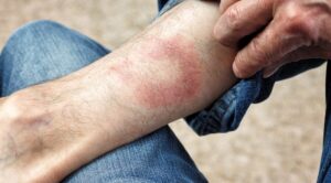 Эритема после клеща