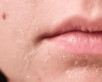 правильний догляд за сухою шкірою