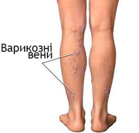 профілактика варикозу