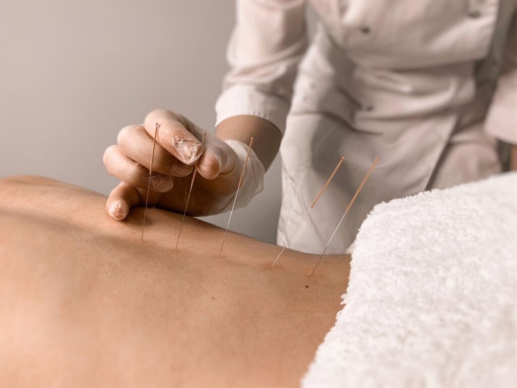 Акупунктурная терапия