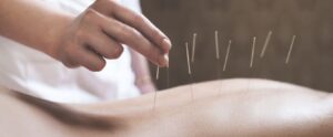 Иглоукалывание для похудения